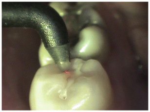 Laser Dentistry