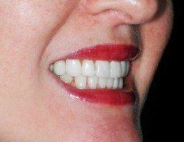 Veneers